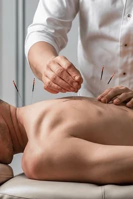 Acupuncture